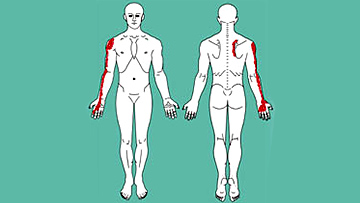 Trigger Point Referral Zone