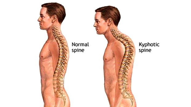 Kyphosis